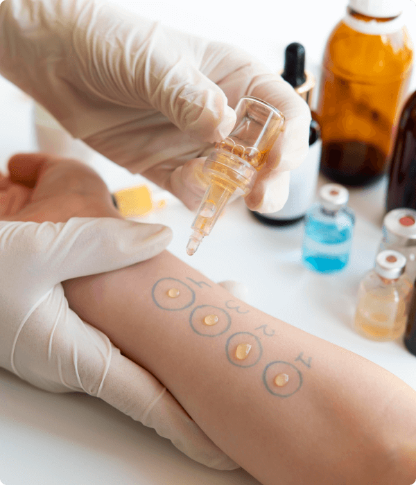 Allergy Skin Testing