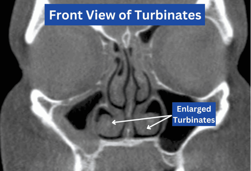 Coronal or Front facing view of a sinus CT scan showing enlarged inferior turbinates