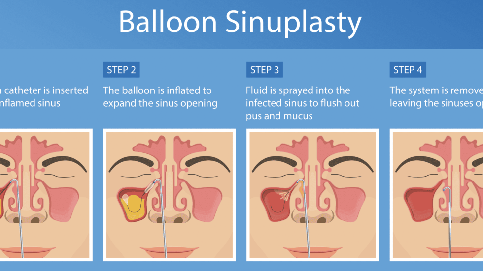 Image depicting sinusitis, a common nasal condition causing inflammation of the sinuses. Learn about treatments and diagnosis options on our website.