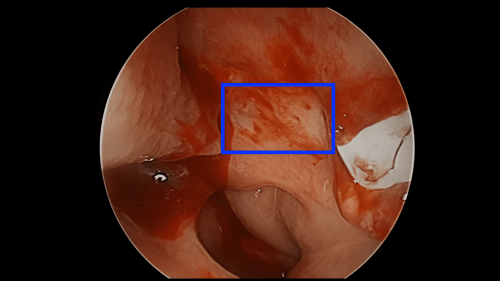 endoscopic view of posterior nasal nerve after treatment with rhinaer