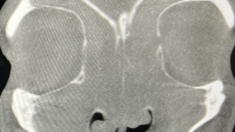 CT scan of sinuses showing severe nasal polyps